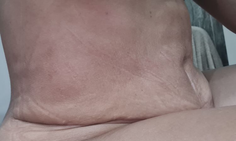 Abdominoplastia y lipo de flancos mal hecha ? - 44046