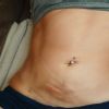 Fibrosis parte inferior abdomen
