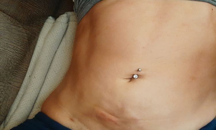 Fibrosis parte inferior abdomen - 44051