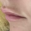 Relleno labios resultado no satisfactorio - 44328