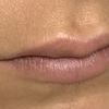 Relleno labios resultado no satisfactorio - 44329