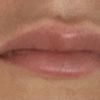 Relleno labios resultado no satisfactorio - 44330