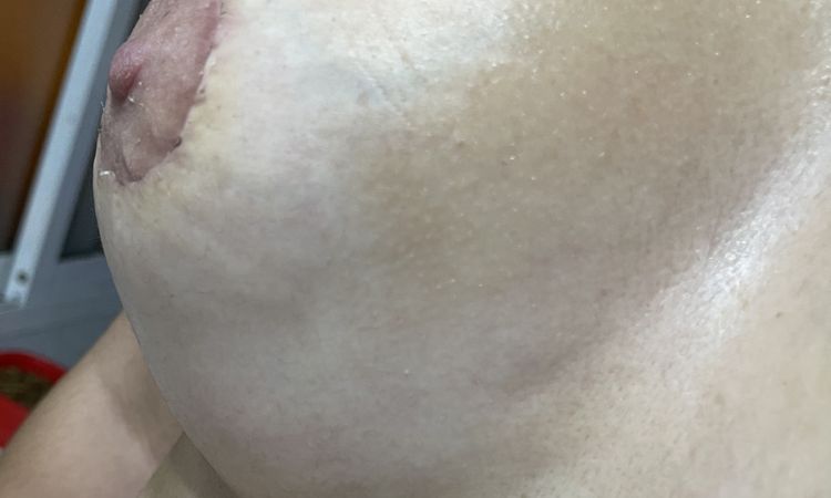 Doble surco? 24 días operada mama tuberosa - 44749