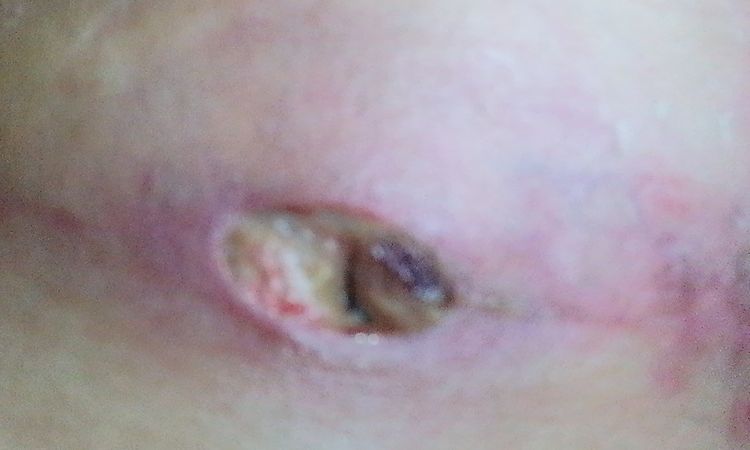 Herida abierta después de pexia - 44751