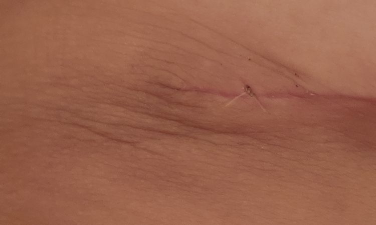 Inflamación y tamaño tras mastopexia reducción - 44756