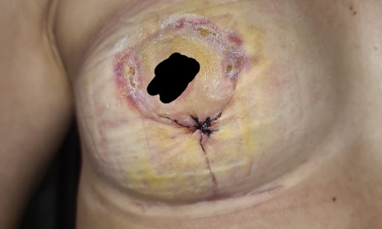 Mastopexia con mal resultado, segunda intervencion? - 44901