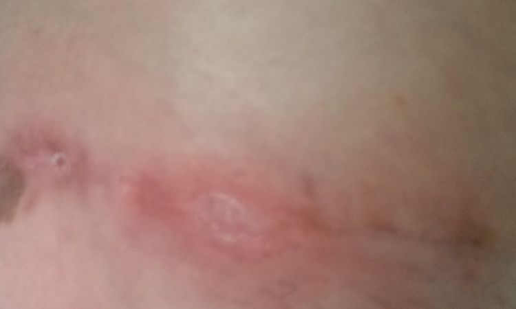 Bultos encima y debajo de la cicatriz de una abdominoplastia - 44907