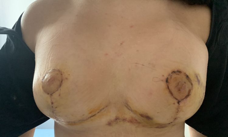 Maxtopexia asimétrica con seno derecho extraño - 44987