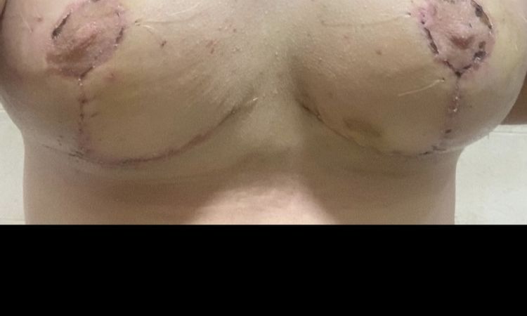 Maxtopexia asimétrica con seno derecho extraño - 44988