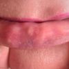 Múltiples granulomas en labios