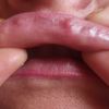 Múltiples granulomas en labios - 45391