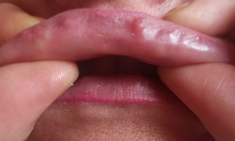 Múltiples granulomas en labios - 45391