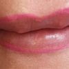 Múltiples granulomas en labios - 45392