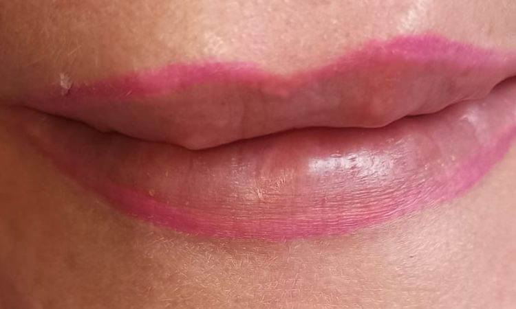 Múltiples granulomas en labios - 45392