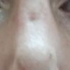 Hundimiento en la nariz por mascarilla tras una rinoplastia - 45411