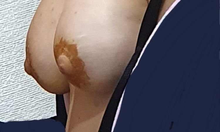 Pezones mal colocados en mastopexia? - 45418