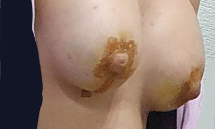Pezones mal colocados en mastopexia? - 45419