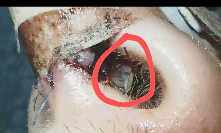 Puntos de rinoplastia - 45519