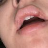 Reacción ácido en los labios? - 45569