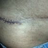 Retoque de cicatriz lateral de abdominoplastia