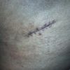 Retoque de cicatriz lateral de abdominoplastia