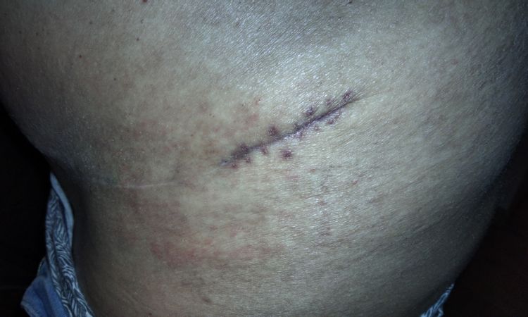 Retoque de cicatriz lateral de abdominoplastia - 45638