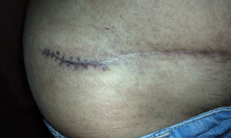 Retoque de cicatriz lateral de abdominoplastia - 45639