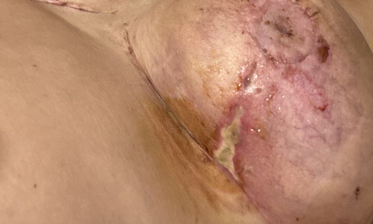 Dos semanas de mastopexia y las heridas no cierran nada - 45707