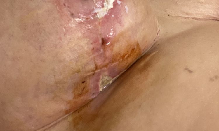 Dos semanas de mastopexia y las heridas no cierran nada - 45708