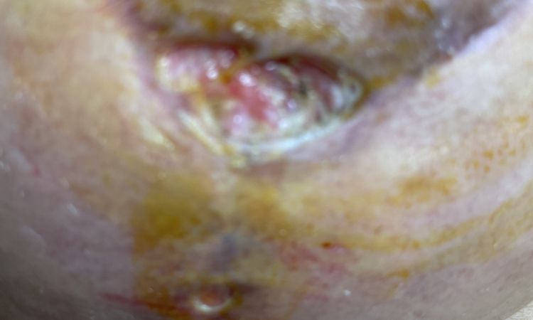 Mis areolas se me abrieron a los 15 días de la mastopexia y no se cierran - 45737