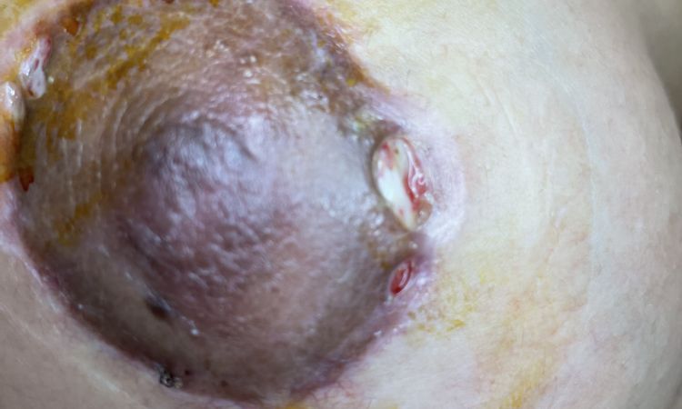 Mis areolas se me abrieron a los 15 días de la mastopexia y no se cierran - 45739