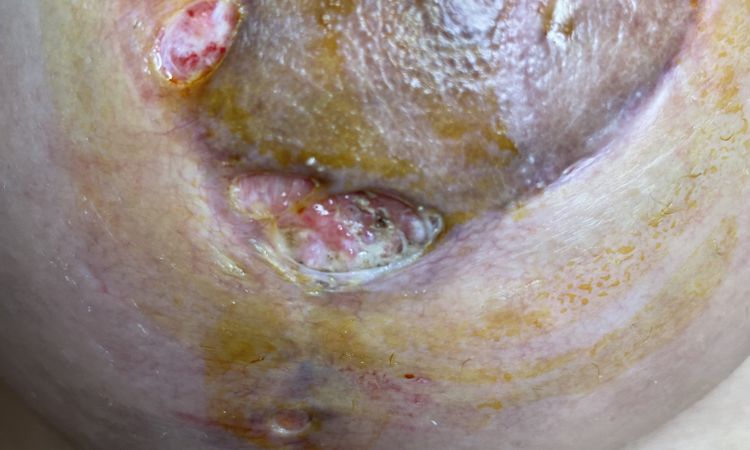 Mis areolas se me abrieron a los 15 días de la mastopexia y no se cierran - 45740