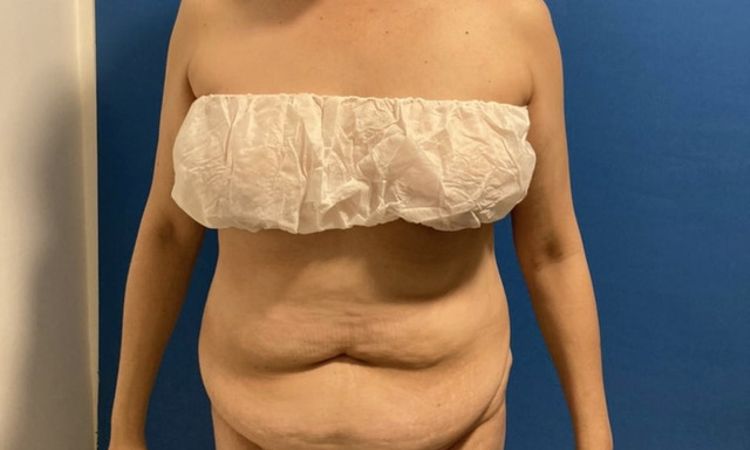 Protuberancias en cicatriz abdominoplastia - 45765