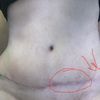 Protuberancias en cicatriz abdominoplastia