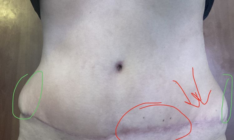 Protuberancias en cicatriz abdominoplastia - 45766
