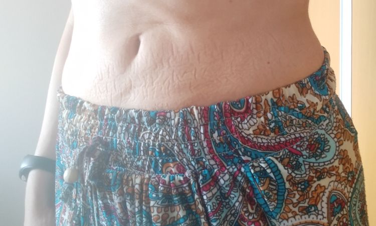 Cómo se elimina un pliegue post liposucción? - 45838