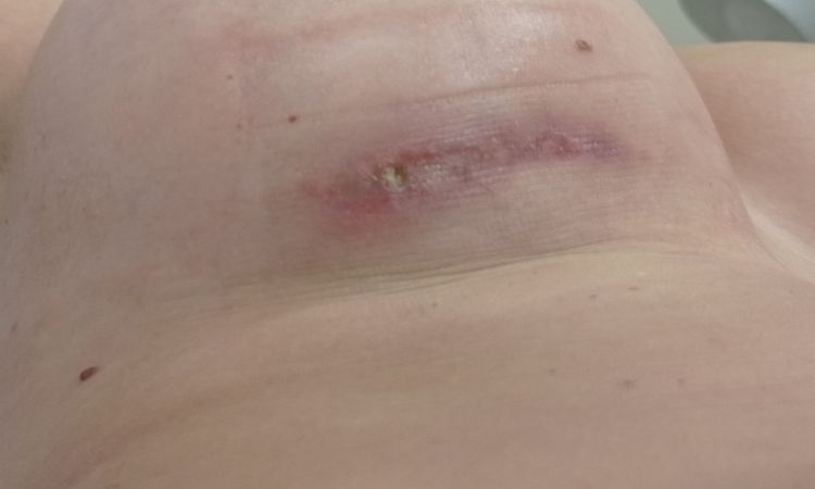 Herida que no cierra tras aumento y mastitis - 45870