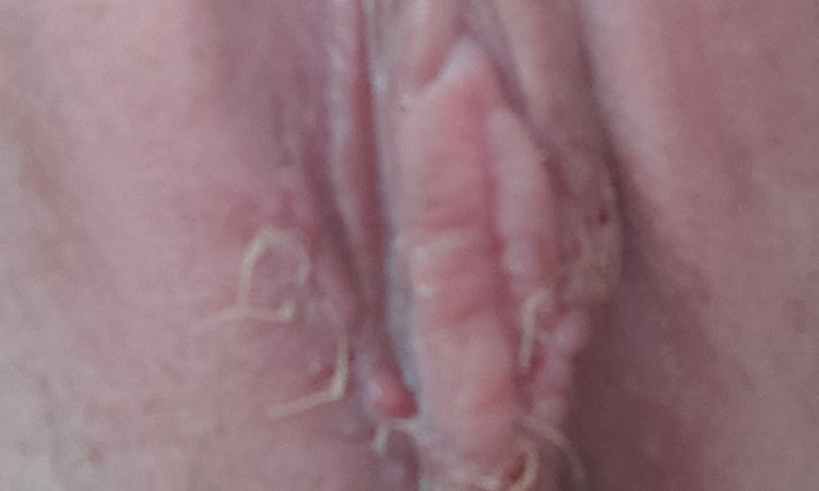Segunda cirugía labioplastia y mucho dolor - 46079