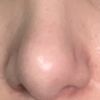 Bola en punta nariz tras rinoplastia secundaria - 46226