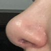 Bola en punta nariz tras rinoplastia secundaria