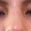 Dorso nasal ancho y plano tras rinoplastia - 46415