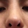 Dorso nasal ancho y plano tras rinoplastia - 46417