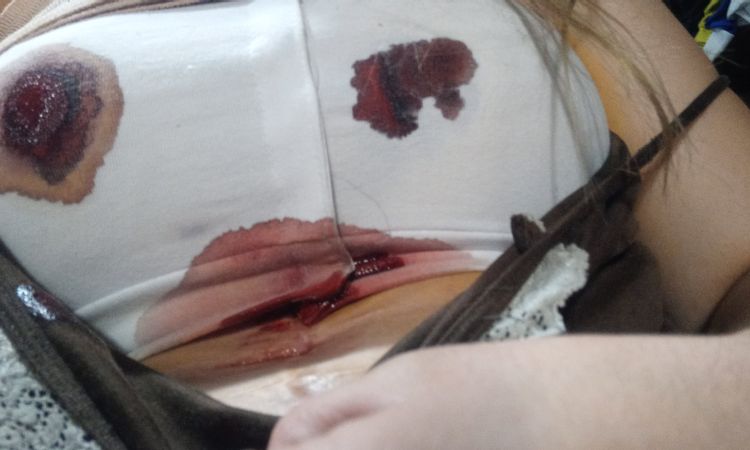 Hematoma y sangrado del pezón tras aumento de pecho - 46528