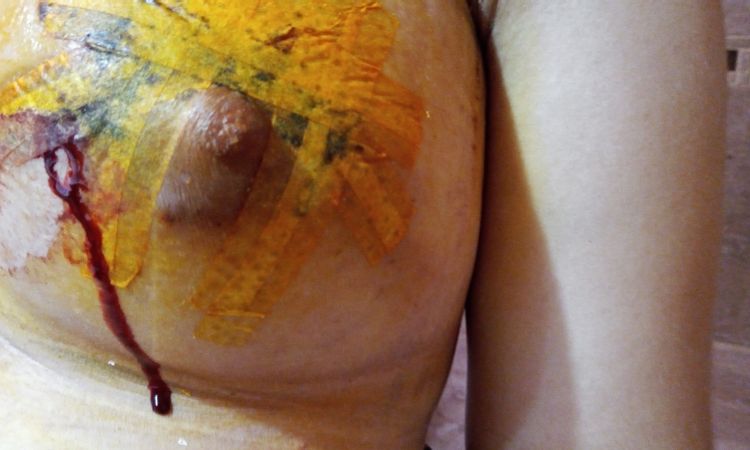 Hematoma y sangrado del pezón tras aumento de pecho - 46529