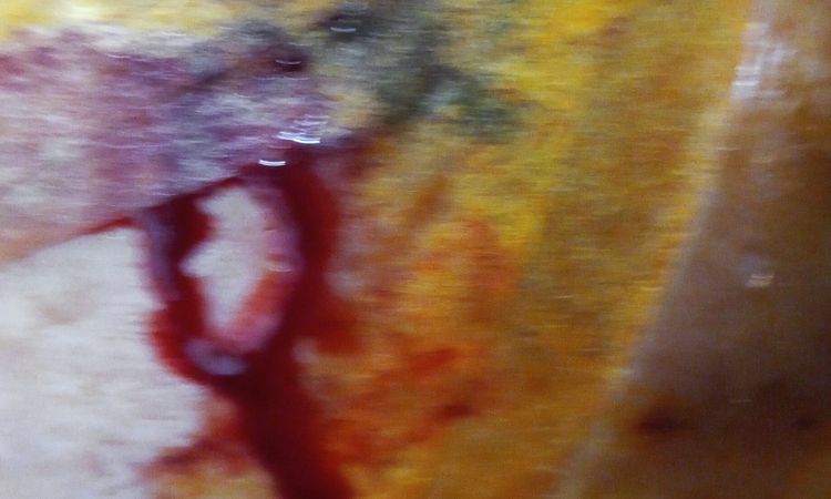Hematoma y sangrado del pezón tras aumento de pecho - 46530