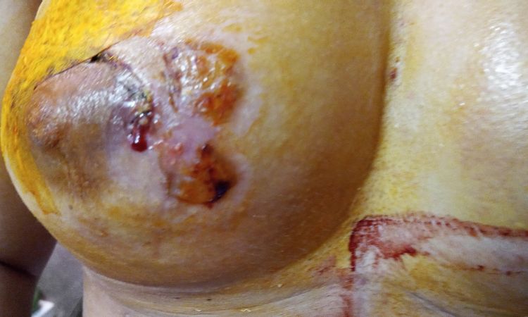 Hematoma y sangrado del pezón tras aumento de pecho - 46531