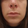 ¿Es normal la asimetría de narinas después de 4 meses tras una rinoplastia? - 46695