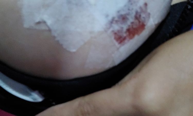 Pezón sangra tras tomar antibióticos en post mastopexia - 46965