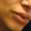 Tratamientos para granuloma en los labios por ácido hialurónico encapsulado