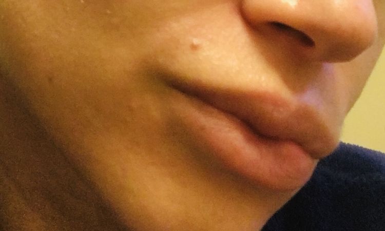 Tratamientos para granuloma en los labios por ácido hialurónico encapsulado - 46968